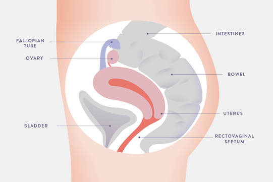 Endometriosis lesions are most commonly found in the pelvic area on organs such as: ovaries, fallopian tubes, bladder, bowels, intestines, rectovaginal septum, and peritoneum